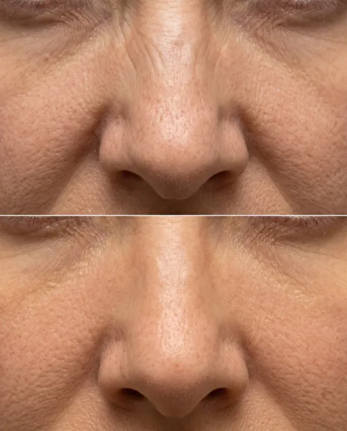 Bunny Lines Botox Ergebnis Vorher Nachher