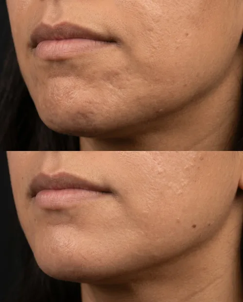 Kinngrübchen Botox Ergebnis Vorher Nachher