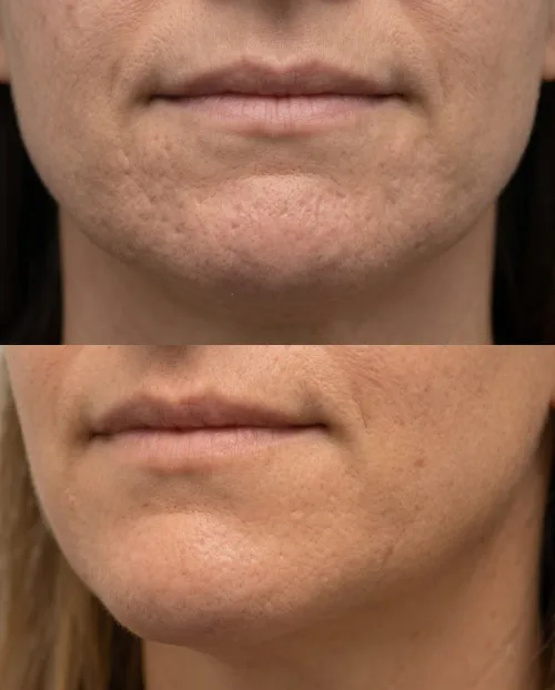 Vorher Nachher Erdbeerkinn Botox Dresden