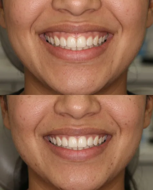 Gummy Smile Behandlung Ergebnis Vorher Nachher