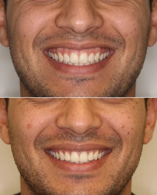 Gummy Smile Ergebnis natürlich