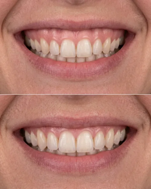 Vorher Nachher Gummy Smile Botox Dresden