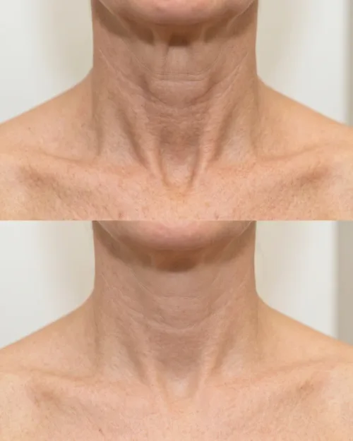 Vorher Nachher Halsfalten Botox Dresden