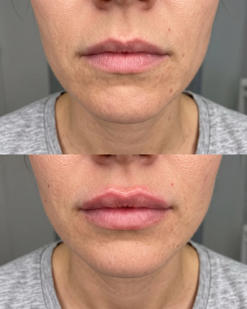 Lip Flip Botox Vorher Nachher