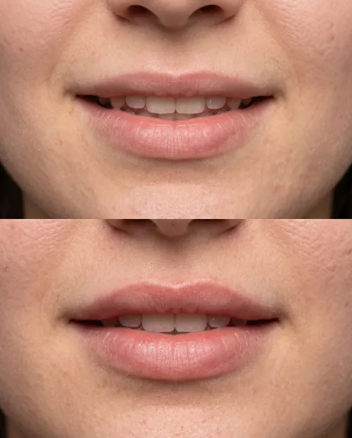 Lip Flip Behandlung Ergebnis