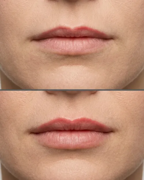 Vorher Nachher Lip Flip Botox Dresden