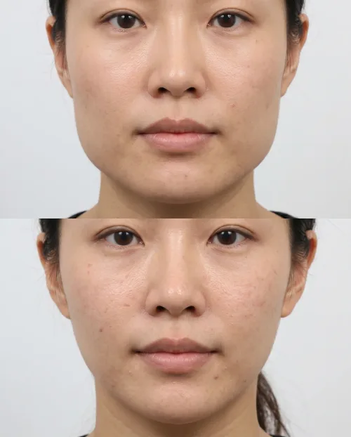 Kieferverschmälerung Botox Vorher Nachher