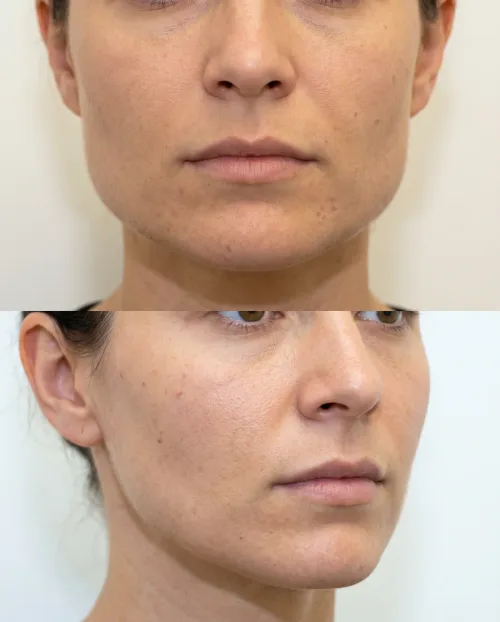 Masseter Botox Ergebnis Vorher Nachher