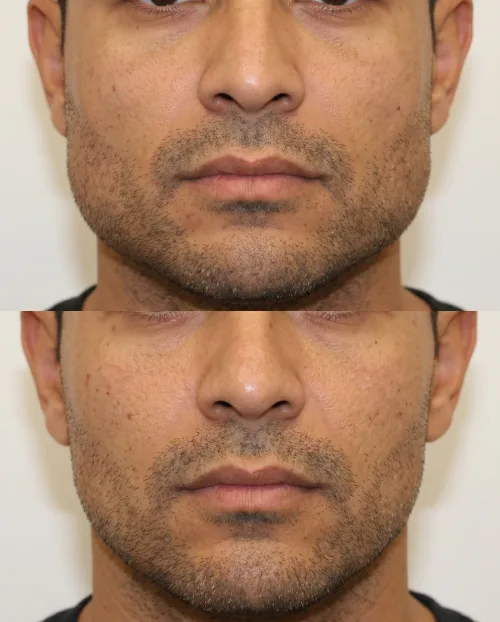 Bruxismus Botox Vorher Nachher Dresden