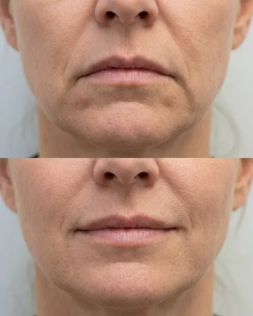 Vorher Nachher Mundwinkel anheben Botox Dresden