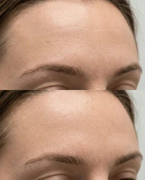 Stirnfalten Botox Ergebnis