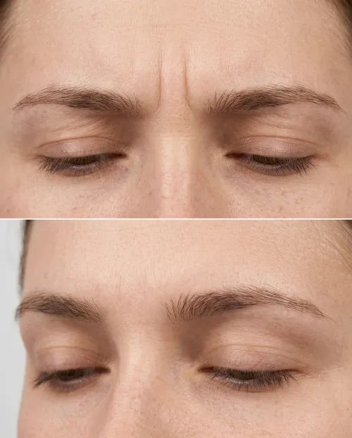 Vorher Nachher Zornesfalte Botox Ergebnis