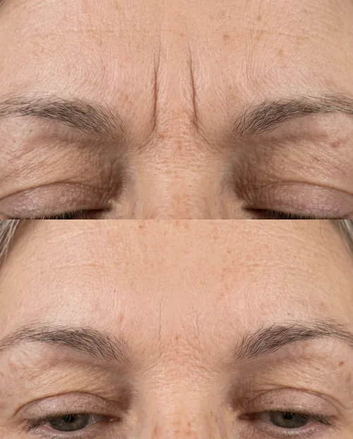 Zornesfalte Botox Ergebnis Vorher Nachher