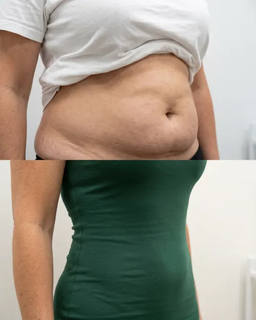 Vorher Nachher Bauch Flanken Lipolyse Dresden
