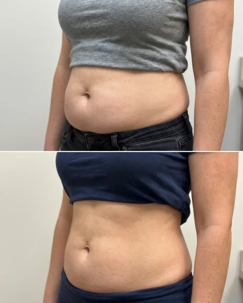 Vorher Nachher Unterbauch Lipolyse Ergebnis Dresden