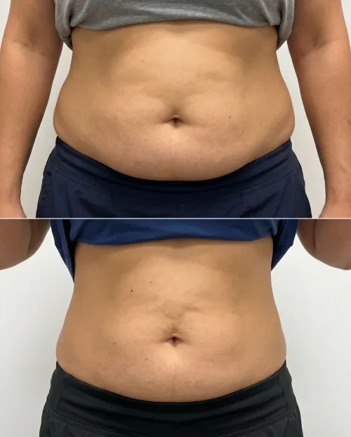 Vorher Nachher Bauch Lipolyse Spritze Ergebnis
