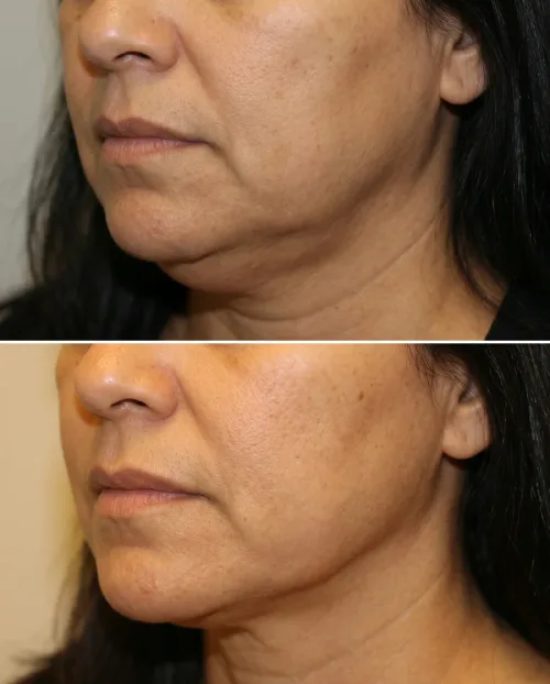 Vorher Nachher Submentales Fett Lipolyse Dresden