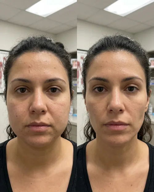 Vorher Nachher Buccal Fat Lipolyse Behandlung