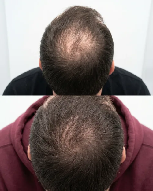Vorher Nachher Haare PRP Mann Krone