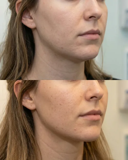 Vorher Nachher Jawline Filler Ergebnis Dresden