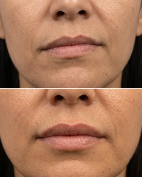 Vorher Nachher Lippenasymmetrie Hyaluron Ergebnis