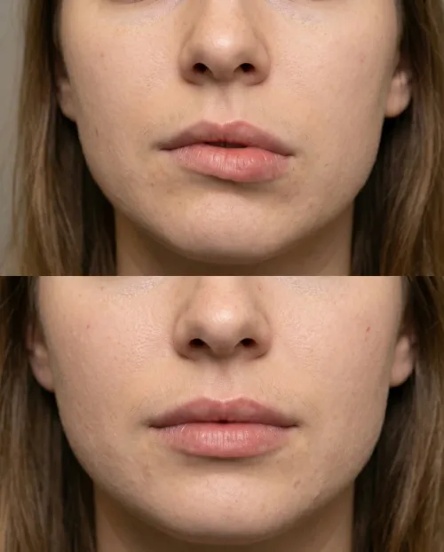Vorher Nachher Lippenkorrektur Asymmetrie Ergebnis