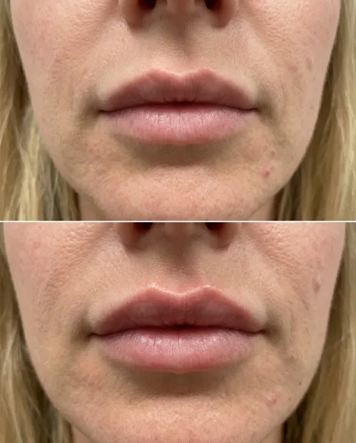 Vorher Nachher Amorbogen definieren Lippen Dresden