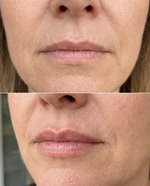 Vorher Nachher Cupid's Bow Lippen Hyaluron Ergebnis