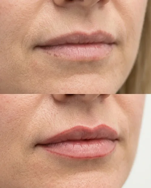 Vorher Nachher Lippenkontur Hyaluron Ergebnis