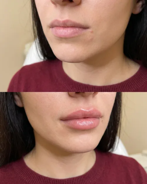 Vorher Nachher Lippenunterspritzung Ergebnis