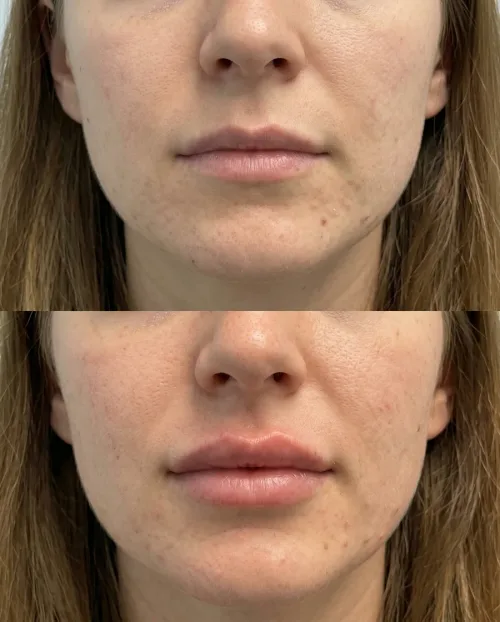 Vorher Nachher Russian Lips Ergebnis Dresden