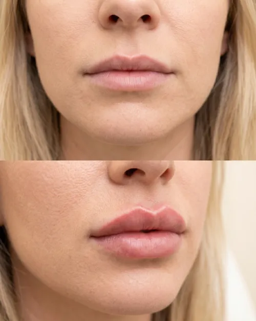 Vorher Nachher Lippen Russian Lips Technik Dresden