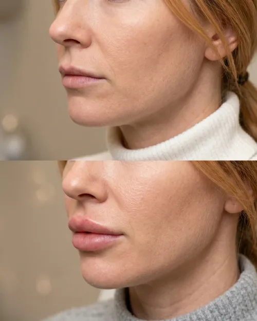 Vorher Nachher Lippenrand definieren Hyaluron