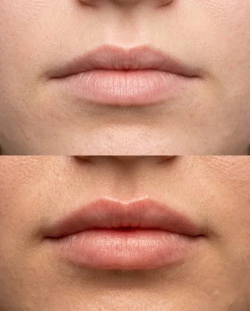 Vorher Nachher Lippenvolumen Hyaluron Ergebnis