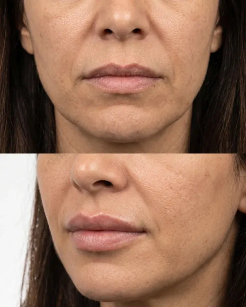 Vorher Nachher Lippen Filler Dresden Ergebnis