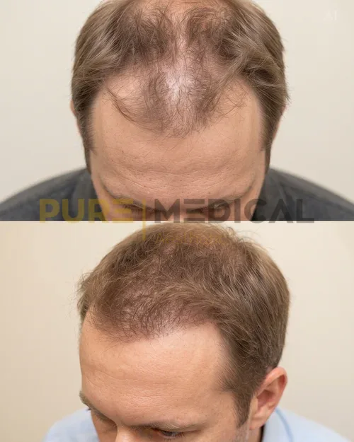 Vorher Nachher Haardichte Krone Mann