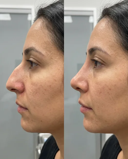 Vorher Nachher Nasen Filler Behandlung Dresden
