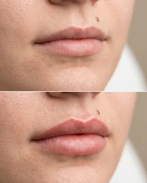 Vorher Nachher Russian Lips Dresden